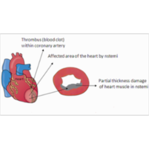 NSTEMI - definition, symptoms, treatment, prognosis