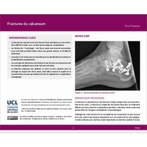 Fractures du calcanéum icon