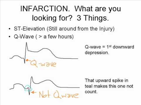 The ST Elevation Song! (What to Look for on an EKG)