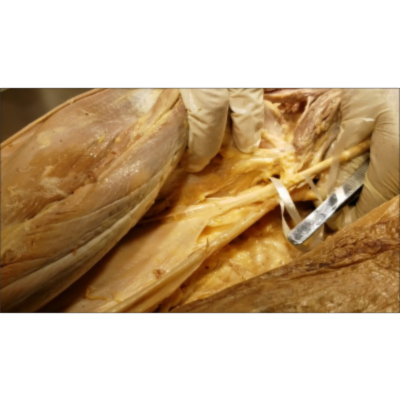 What is the Unique Pes Anserinus [Goose-Foot] Insertion - Sanjoy Sanyal icon