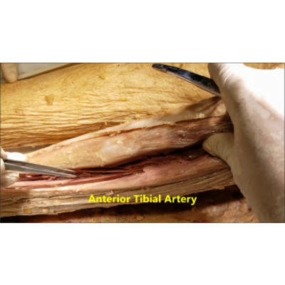 Leg Anterior Compartment Dissection-Foot Drop-Shin Splint-Ski Boot Syndrome - Sanjoy Sanyal icon