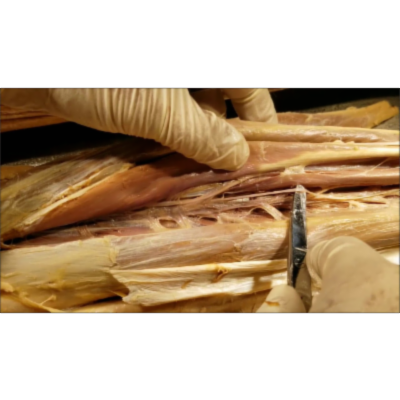 Complete Fibular [Peroneal] Nerve Distribution in the Leg-Associated Syndromes - Sanjoy Sanyal icon