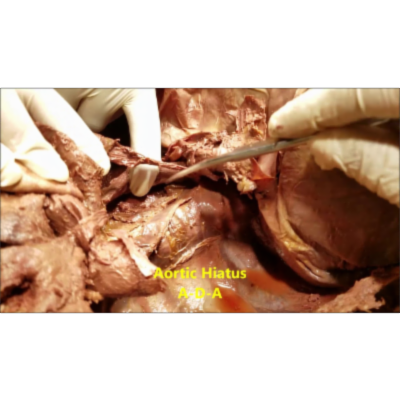 In-Depth Surgical Dissection of Mediastinum-Great Vessels and Clinical Aspects - Sanjoy Sanyal icon