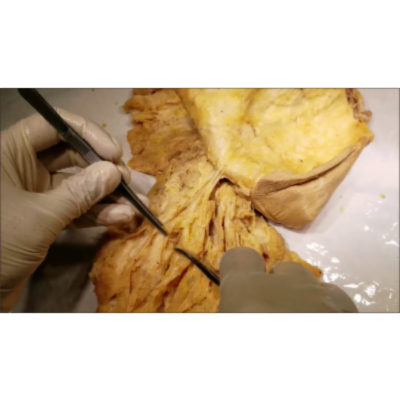 Female Mammary Architecture Demonstration – Breast Cancer and Mastectomy Principle – Sanjoy Sanyal icon