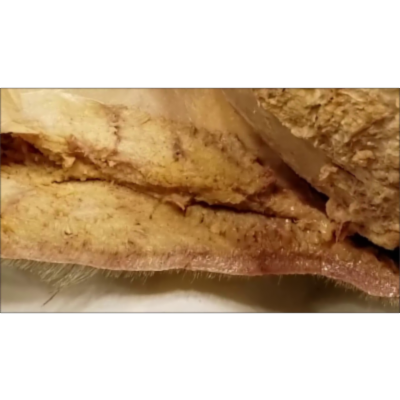 Scalp Dissected From Surgical Perspective–Danger Layer–Raccoon Eyes–Native Scalping–Sanjoy Sanyal icon