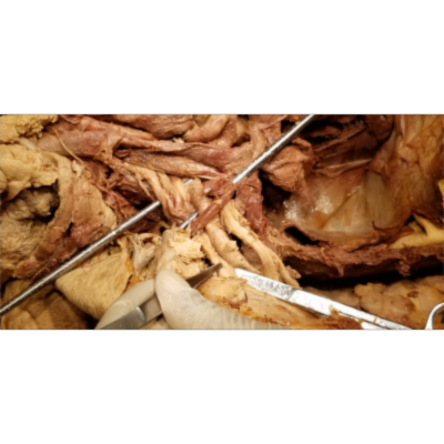 Bilateral Indeterminate Anomaly of Brachial Plexus - Possibly Prefixed - Sanjoy Sanyal icon