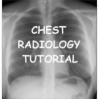 Chest Xray Tutorial