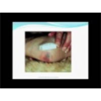 What are Pressure Ulcers or Bed Sores? icon