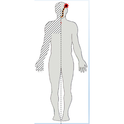 Motor System Patient Case, Stroke icon