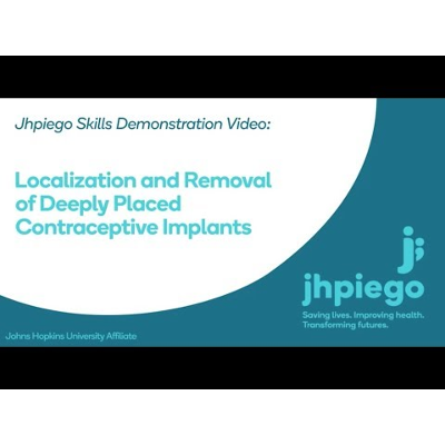 Localization and Removal of Deeply Placed Contraceptive Implants