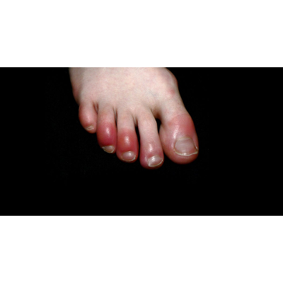 What Is ‘Covid Toe’? Maybe a Strange Sign of Coronavirus Infection (Published 2020) icon