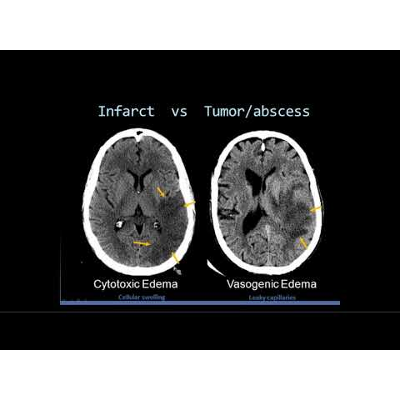 Intro to Head CT Part II: Evaluation of Ischemic Stroke