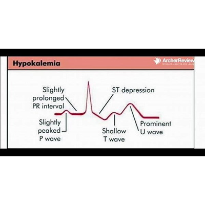 electrolytes and heart arrhythmia - Bing video icon