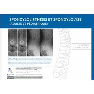 Spondylolisthésis et spondylolyse  (Adulte et pédiatrique) icon