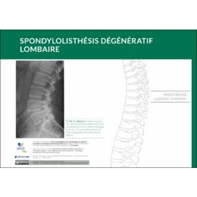 spondylolisthésis dégénératif lombaire icon