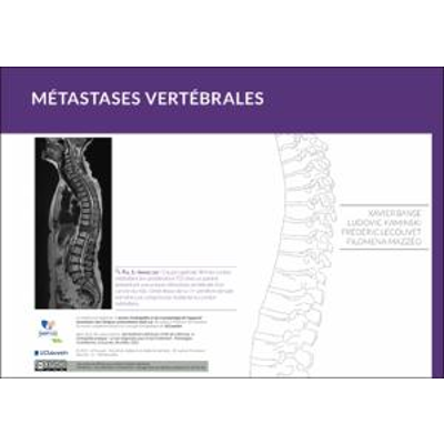 Métastases vertébrales icon