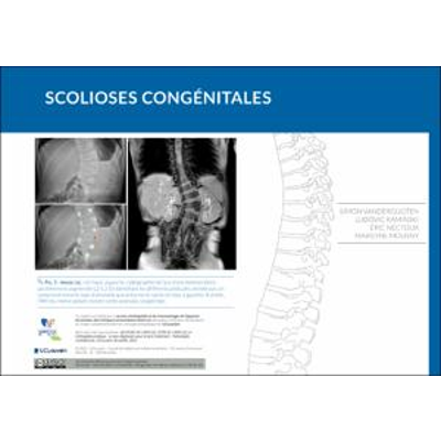 Scolioses congénitales icon