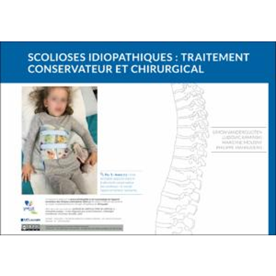 Scolioses idiopathiques : traitement conservateur et chirurgical icon