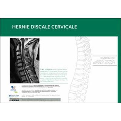 Hernie discale cervicale icon