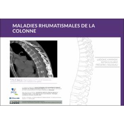Les maladies rhumatismales dans la colonne icon