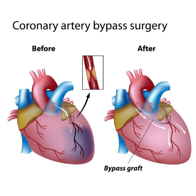 Heart Bypass Surgery Explained In Incredible Pictures &bull; MyHeart