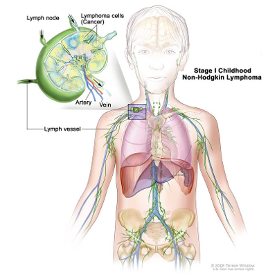 Childhood Non-Hodgkin Lymphoma Treatment icon