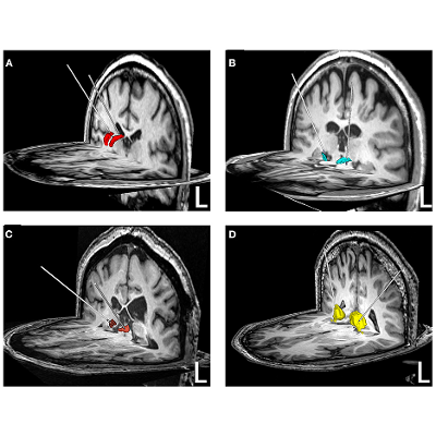 Frontiers | Deep brain stimulation for patients with refractory epilepsy: nuclei selection and surgical outcome icon