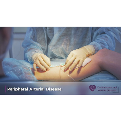Limb Preservation and Amputation Prevention | Peripheral Arterial Disease | CTVS Texas icon