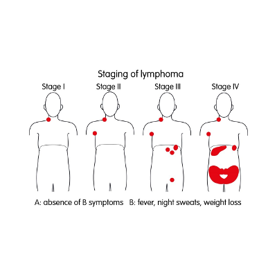 Childhood Hodgkin Lymphoma Disease – Stages and Prognosis - ACCO