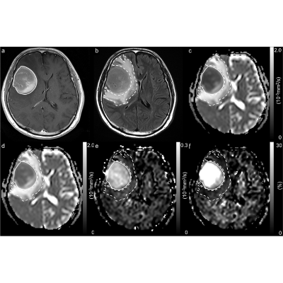 Differentiating primary central nervous system lymphoma from glioblastoma by time-dependent diffusion using oscillating gradient - Cancer Imaging icon