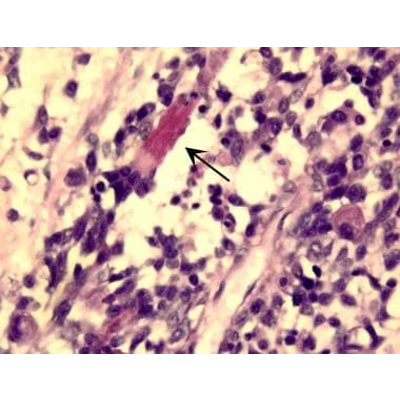 Pathology - Rhabdomyosarcoma: Practice Essentials, Histology, Presentation and Evaluation icon