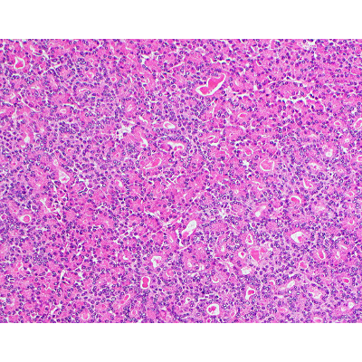 Pancreatoblastoma - Pathology icon