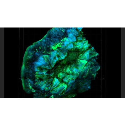 Ovarian, Fallopian Tube, and Primary Peritoneal Cancer—Patient Version icon